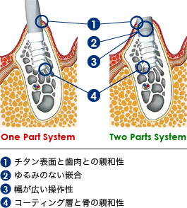 AQBインプラントシステムの特長