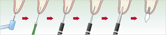 O.A.Mインプラントシステムの手術手順
