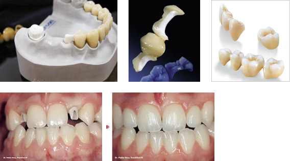 セルコンによる補綴物の完成イメージ