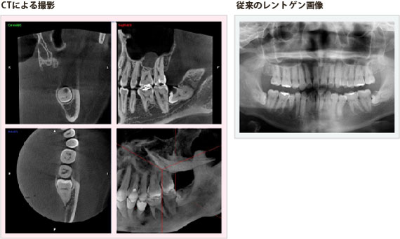 歯科用CTとレントゲンで撮影した画像の比較2