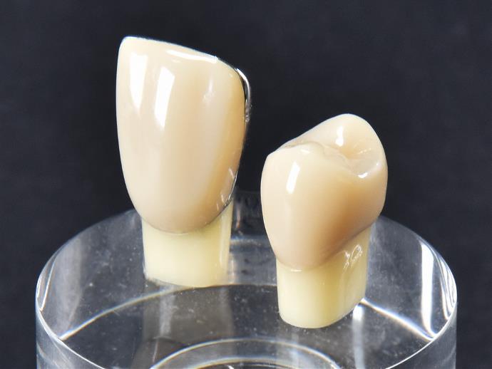 硬質レジン前装